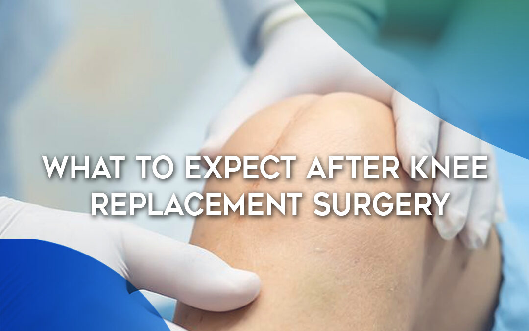 What to Expect After Knee Replacement Surgery